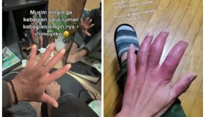 Yang Berada di Jepang Hati-hati dengan Serangan Shimoyake, Kulitmu Bisa Rusak Seperti Ini