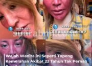 22 Tahun Tak Pernah Hapus Makeup, Wanita Ini Alami Wajah Membengkak Seperti Bertopeng
