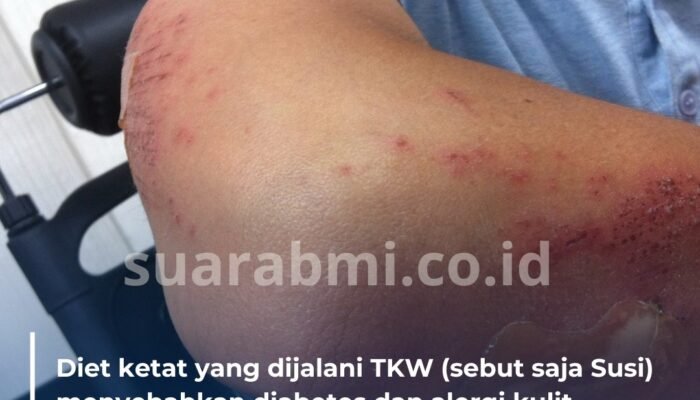 Jalani Diet Ketat agar Bisa Tampil Aduhai, TKI Ini Justru Terjerat Diabetes