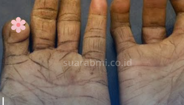 Heboh PMI Penderita Kusta jadi Kasus Pertama di Rumania Setelah 44 Tahun Nihil Temuan